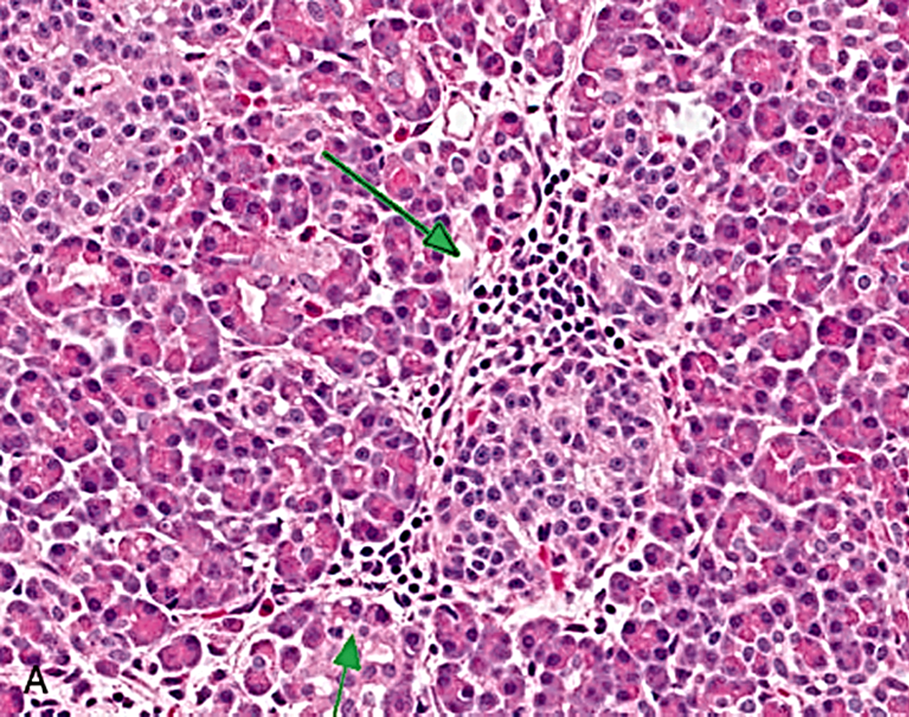 <p>TYPE 4 HYPERSENSITIVITY</p><p>Targets pancreatic beta-islets for the glutamate decarboxylase receptor, insulin receptor and insulin; infiltrates make their way into the islets.</p>