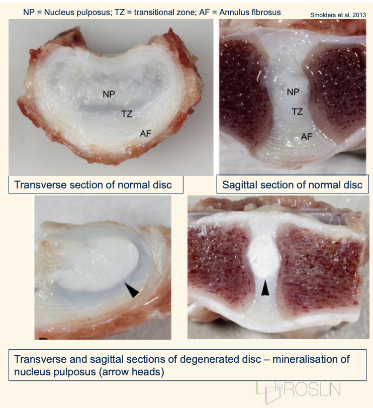 <p>Degeneration of the intervertebral disc (multifactorial)—&gt; mineralisation/ whitening of nucleus propulus </p><ul><li><p>Process of aging</p></li><li><p>Biomechanical strain &amp; trauma</p></li><li><p>Genetic (FGF4 gene) </p><ul><li><p>Chondrodystrophic breeds eg Dachshund, French Bulldog.</p></li><li><p>short limb phenotype FGF4</p></li></ul></li></ul><p></p>