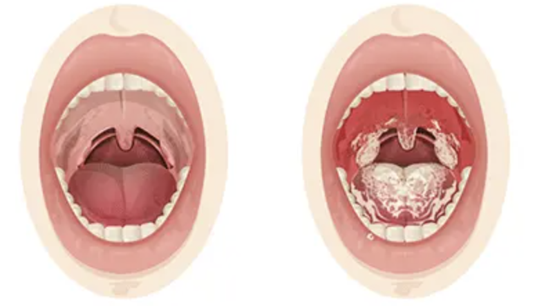 <ul><li><p>this disease is also called <em>oral candidiasis</em>, so it's a <em>FUNGAL</em> disease. </p></li><li><p>caused by the <strong>yeast strain Candida albicans</strong>.</p></li></ul><p></p>