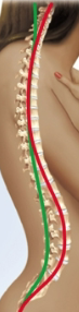 <p>Hyperlordosis</p>