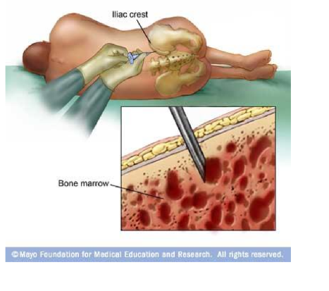 <p>A procedure to obtain a sample of bone marrow for examination, typically used to diagnose blood disorders or malignancies. </p>