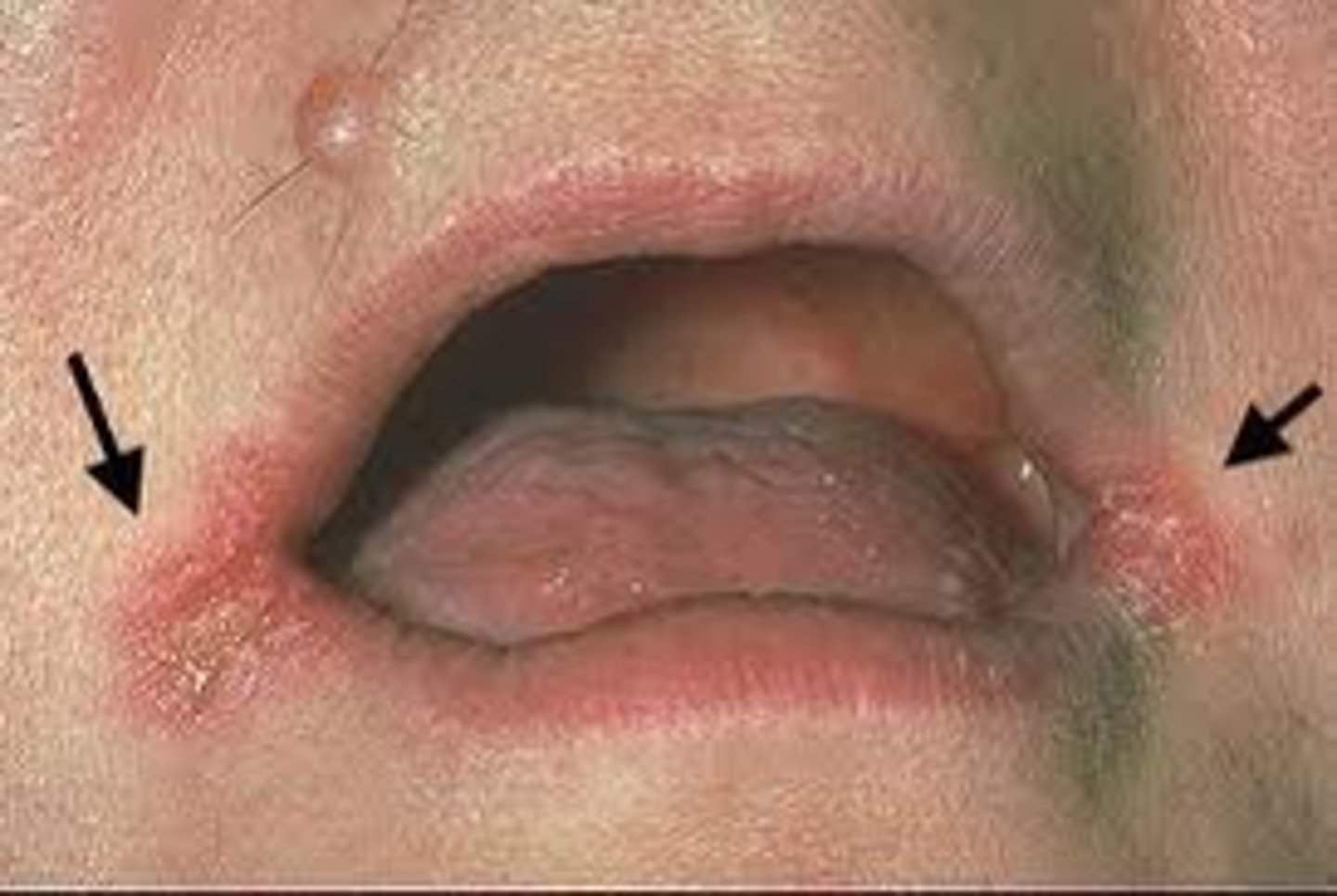 <p>painful, erythematous, fissured patches of commissures of the mouth; usually bilateral</p><p>usually candida overgrowth, can also be caused by s. aureus or strep</p>