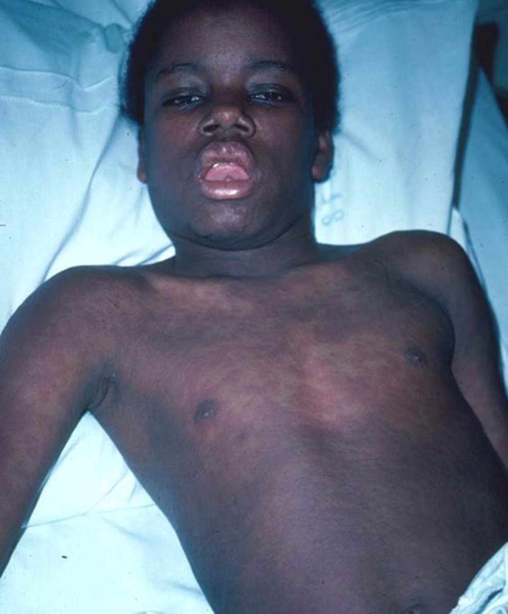 <p>A patient present with an skin eruption and systemic sx of exanthem, erythematous dentrofacial swelling, fever, malaise, lymphadenopathy, and involvement of other organs (liver, kidneys). What do you suspect?</p>