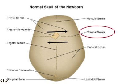 <ol><li><p>premature fusion of<u> BOTH coronal sutures </u></p></li><li><p>can have fusion of one coronal suture </p></li></ol><p></p>