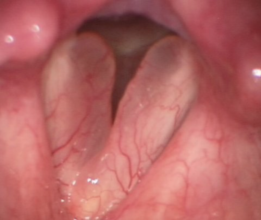 <p>aka polypoid corditis, or if extreme called polypoid degeneration; buildup of fluids or polyps in the superficial lamina propria, which causes <strong>edema </strong>or swelling of the vocal folds</p>