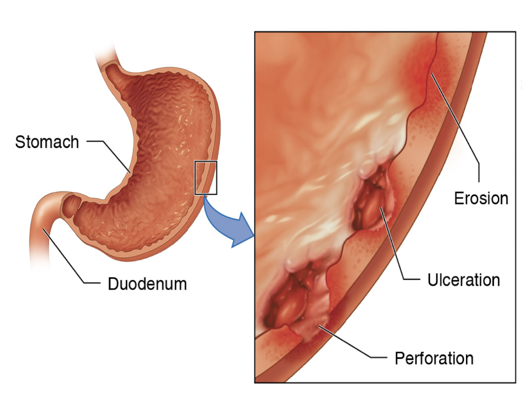 <ul><li><p>Etiology </p><ul><li><p>Various causes </p></li><li><p>Most common: H. pylori infection and NSAID use</p></li><li><p>Contributing factors include smoking, excessive alcohol use, drug use, emotional stress, and psychosocial components </p></li></ul></li><li><p>Pathogenesis</p><ul><li><p>Increased gastric acid secretion or a weakened mucosal barrier leads to mucosal erosion and psychosocial components </p></li></ul></li></ul><p></p>