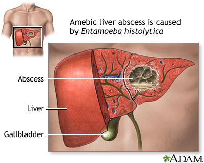 <p>E. HISTOLYTICA DISEASE/S: MOST COMMON FORM</p>