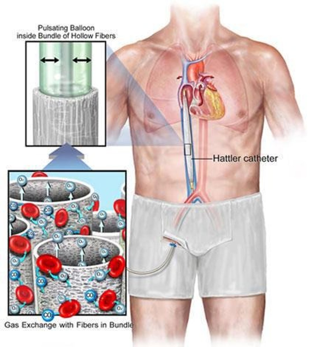 <p>Devices assisting or replacing lung function.</p>