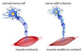 <p>It’s an autoimmune disease that causes demyelination of axons. There is a decreased number of myelin-making cells. There are more females than males with MS. Immunosuppressants can help because they reduce inflammation. </p><p></p>