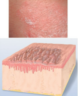 <p>prolonged intense scratching leading to thickened skin producing tightly packed set of papules</p>