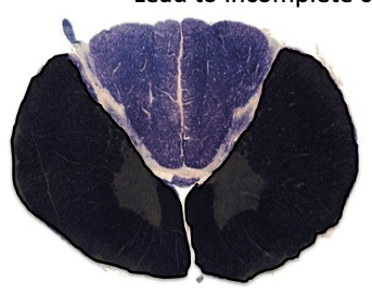 <p>motor paralysis below the level of the lesion as well as the loss of pain and temperature at and below the level of the lesion</p><p>black = lesion</p>