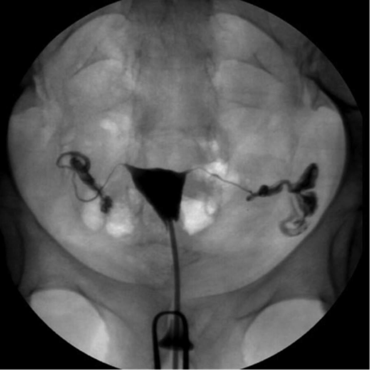 <p>radiographic demonstration of female reproductive tract w/ contrast medium</p>
