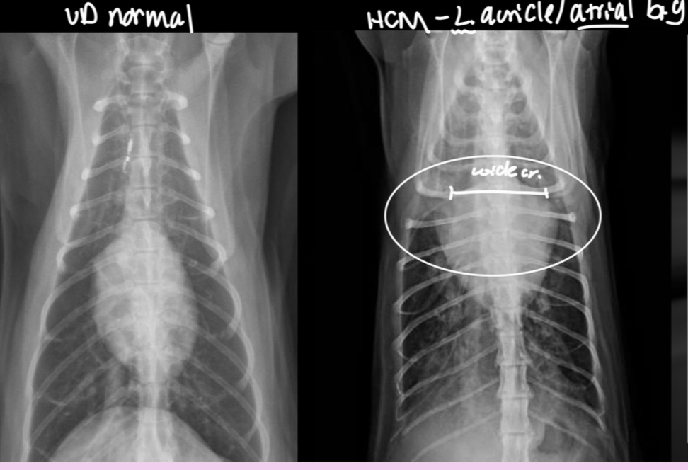<p>-change in shape = abnormal (hard to tell what chamber affected tho) —> results in valentine shape</p><p>-HCM —> big LA and L. Au —> probably baggy left atrium that makes the whole thing look “huge”</p>