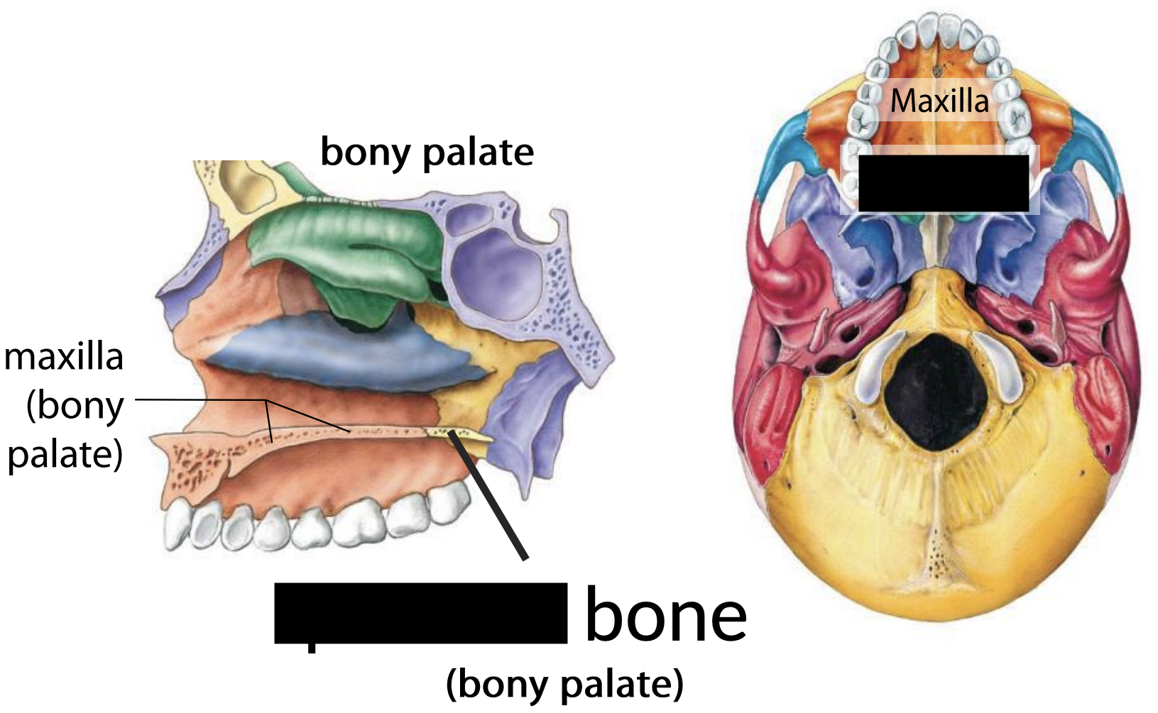 What facial bones is this?