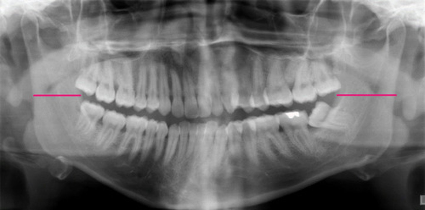 <p>What error is present on panoramic? *Hint pay attention to the width of the ramus</p>