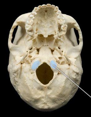 <p>occipital condyle</p>