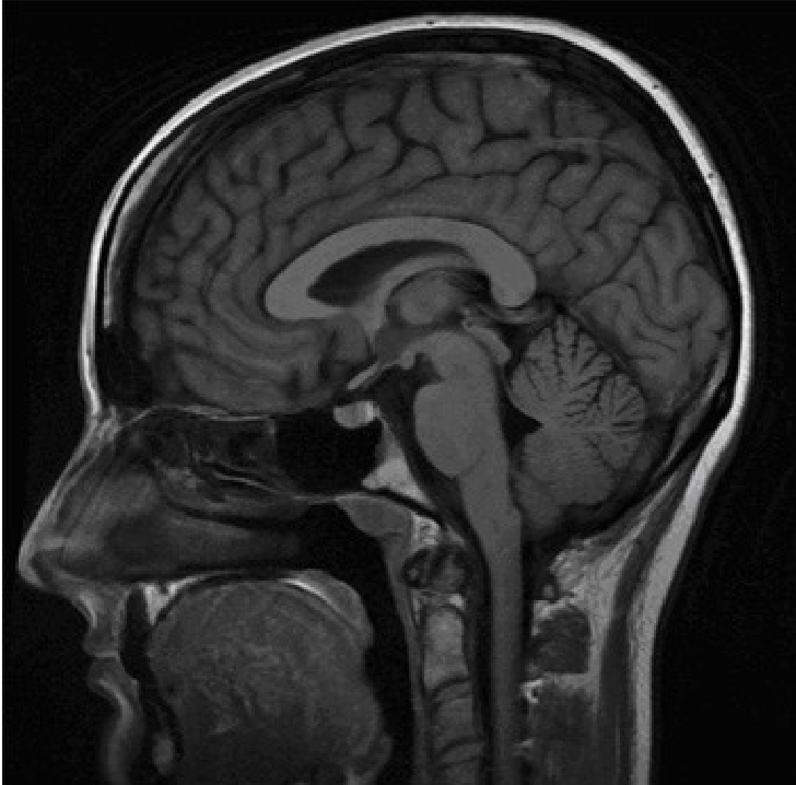 <p>alcohol abuse, with malnutrition and dehydration, presents with delusions hallucinations, unable to recall why hes in hospital and doesn’t know age, mostly likely diagnoses is ______ syndrome</p>
