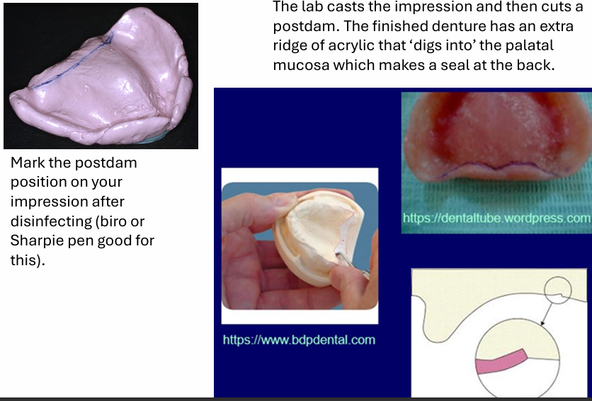 <ul><li><p>the lab casts the impression and then cuts a post dam. the finished denture has an extra ridge of acrylic that&nbsp;‘digs into’ the palatal mucosa which makes a seal at the back</p></li></ul><p></p>