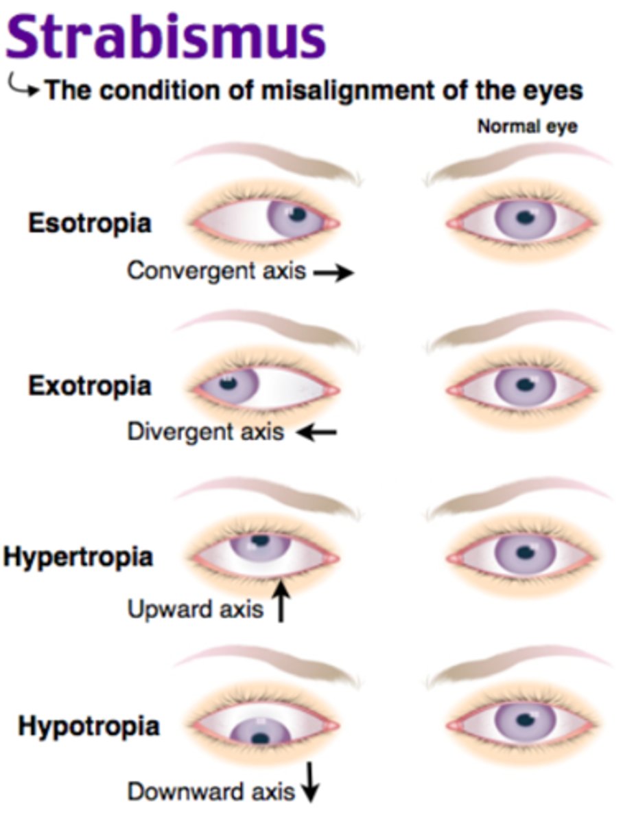 <p>C. Exodeviation / Esodeviation</p><p>* Esotropia means that one eye is deviated inward and is often called crossed eyes</p><p>* Exotropia is when one or both eyes look outward, often called wall-eyed</p><p>* A tropia is always present, while phorias are there "some of the time".</p>