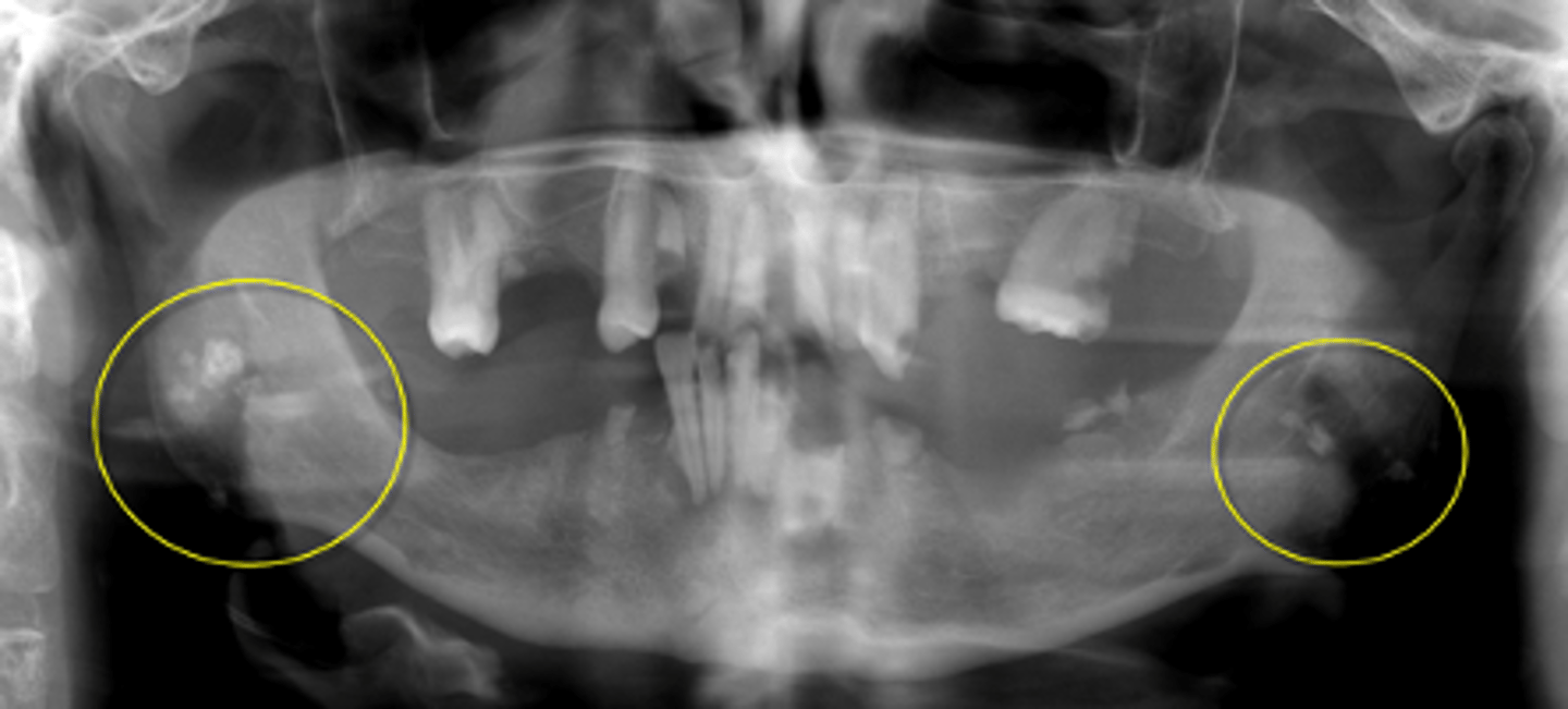 <p>ID the calcified abnormality:</p>