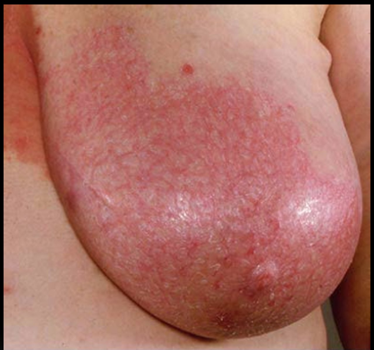 <p>Define Condition:</p><p>Infex of Breast Tissue</p><p>-Path: Usually lactational (d/t blocked duct/cracks in nipple) + bacterial Infex (MCC = S. aureus)</p><p>-Sx/PE:</p><p>&gt; Breast pain</p><p>&gt; Breast Edema</p><p>&gt; Erythema around breast</p><p>&gt; Fever</p><p>&gt; Chills</p><p>&gt; Generalized Malaise</p><p>-Tx:</p><p>&gt; Abx (Dicloxacillin) + Supportive Care</p><p>&gt; NSAIDs</p><p>&gt; CONTINUE BREAST BEEDING/Pumping</p><p>&gt; Ice Packs/Cold Compress</p>