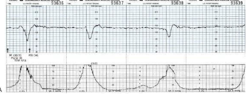 <p>The nurse is monitoring a patient in labor and notes this fetal heart rate pattern on the electronic fetal monitoring strip (see figure). Which is the most appropriate nursing action at this time?</p><p>a. Decrease the rate of the IV fluids. </p><p>b. Document the fetal heart rate pattern. </p><p>c. Explain to the patient that the pattern is normal. </p><p>d. Perform a vaginal exam to detect a prolapsed cord.  </p>