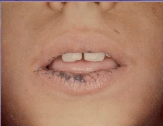 <p>which of the following features is not a characteristic of this condition </p><p>intestinal polyps </p><p>supernumerary teeth </p><p>autosomal dominant </p><p>increased risk for cancer </p>