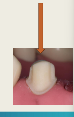 <ul><li><p>The direction in which the crown is placed and removed</p></li><li><p>Determined by the<strong> long axis</strong> of the tooth (Preservation of tooth)</p></li><li><p>Affected by the <strong>taper</strong> and <strong>axial wall</strong> alignment </p></li><li><p>Essential for proper seating and retention</p></li></ul><p></p>