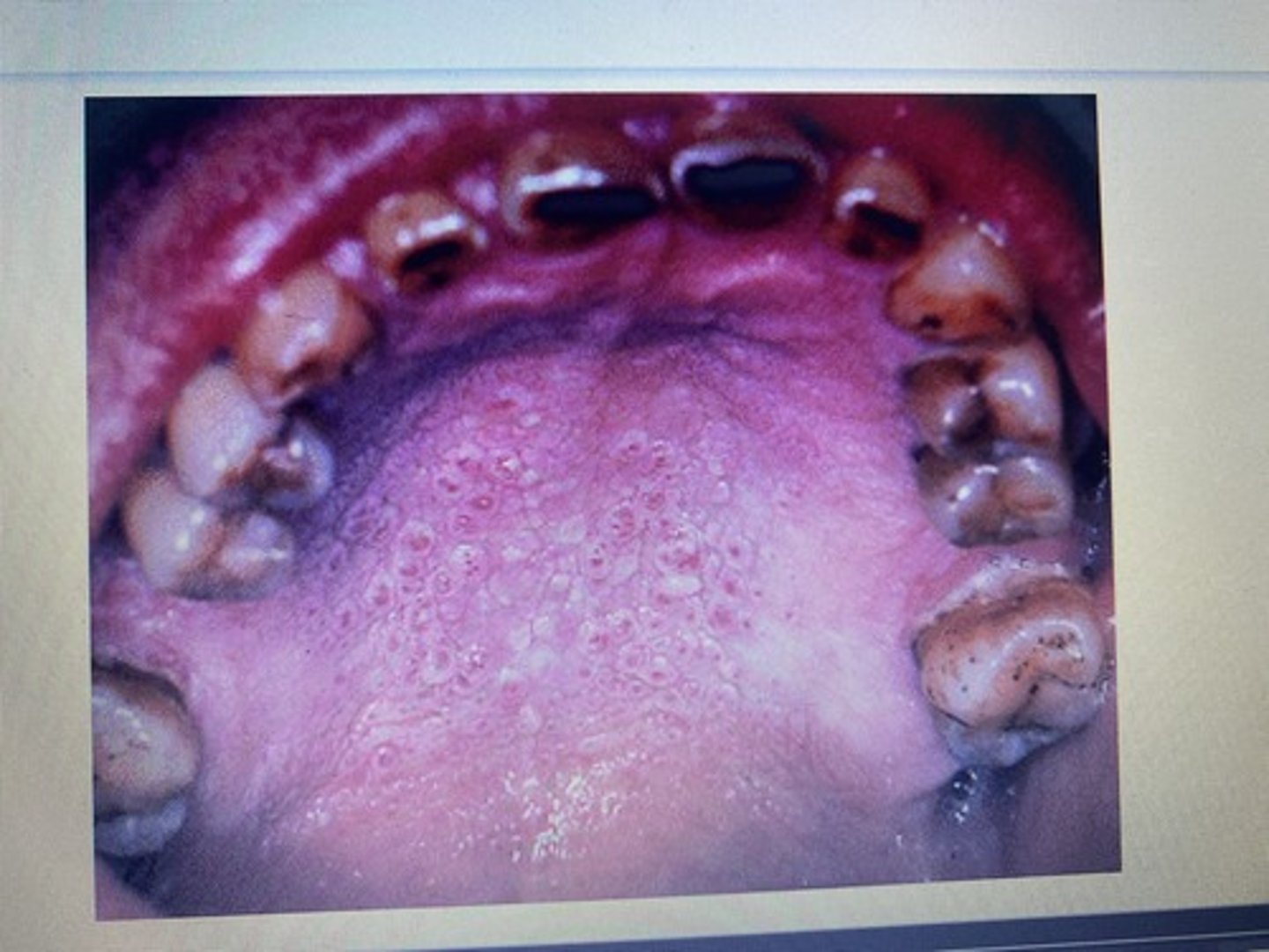 <p>Abnormal; Nicotine Stomatitis</p>