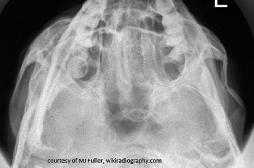 <p>Name one functional complication of a zygomatic arch fracture.</p>
