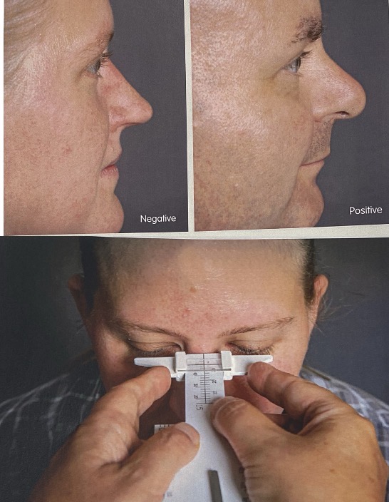 <p>Before taking the measurement, observe the patient from the side.</p><p>A negative bridge projection is seen when the lashes project outwards beyond the crest of the bridge of the nose</p><p>A positive bridge projection is seen when the bridge of the nose projects outwards beyond the lashes.</p><p>Measurement- </p><p>Place the cursor on the ruler so that the cut-out section is on the underside of the ruler and facing the patient as in the diagram above.</p><p>Place the edge of the ruler on the bridge of the patient's nose and move the cursor until it just misses the tips of the lashes. Take the measurements using the scale on the upper side of the ruler, carefully noting the zero of the scale.</p>