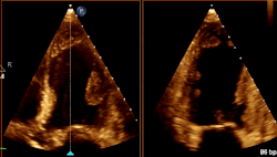 <p><span><span>What cardiac condition is demonstrated in this image?</span></span></p><p>LV apical aneurysm</p><p>Non-compaction cardiomyopathy</p><p>LV Apical thrombus</p><p>Apical Hypertrophic Cardiomyopathy</p>