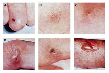 <p>-1-3% of infected patients</p><p>-associated with female sex and menstruation</p><p>-deficiency in C5-C8 may increase susceptibility</p><p>-symptoms: fever, pustular skin lesions, tenosynovitis, migratory polyarthralgia (septic arthritis in one or two joints), asymmetric arthralgia and hepatitis, endocarditis, meningitis rarely occurs</p><p>-diagnosis: gram stain, culture, nucleic acid amplification</p>