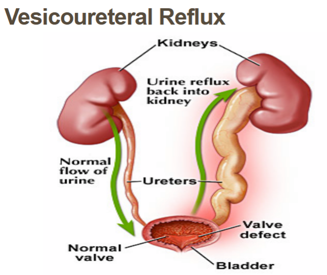<p>disorder of the vesicoureteral junction which causes abnormal backflow of urine into ureters that could lead to hydronephrosis (kidney swelling), tested with voiding cystourethrogram (VCUG): cath puts contrast dye in bladder and child bears down to void to see reflux, treated with reimplantation surgery</p>
