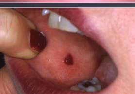<p>a larger area of hemorrhage (max 1 cm) under the skin or mucous membranes </p>
