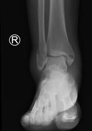 <p>Fracture of both malleoli One side is usually spiral or oblique and the other transverse</p>