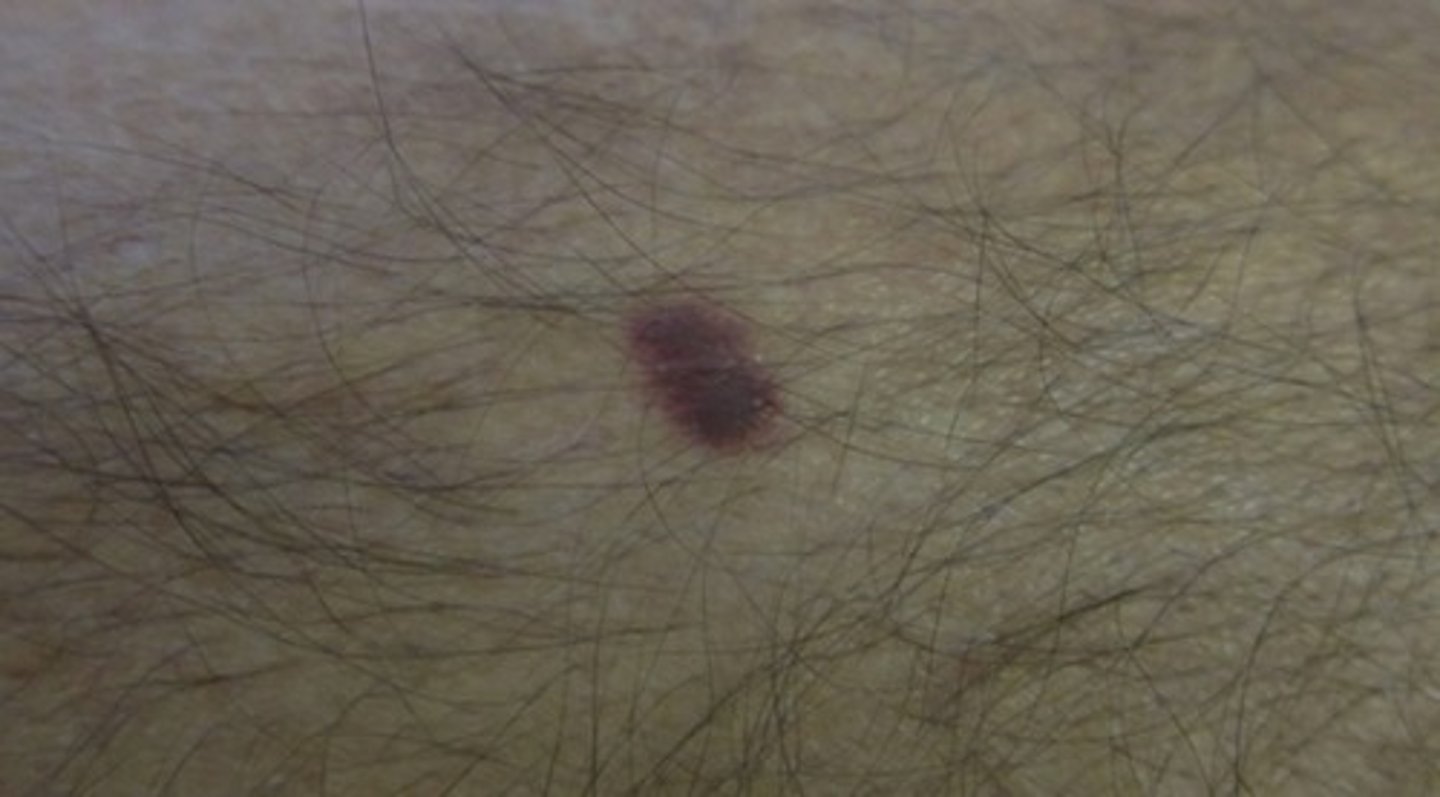 <p>Histo</p><p>-Spindle + Endothelial cell proliferation </p><p>-RBC extravasation + inflammation</p>