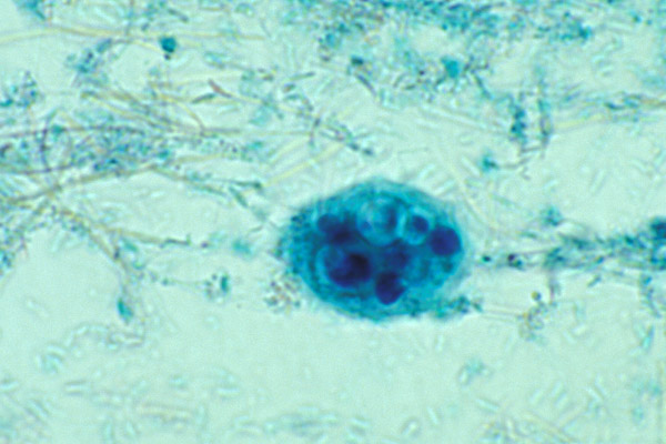 <p>Has ingested WBCs</p>