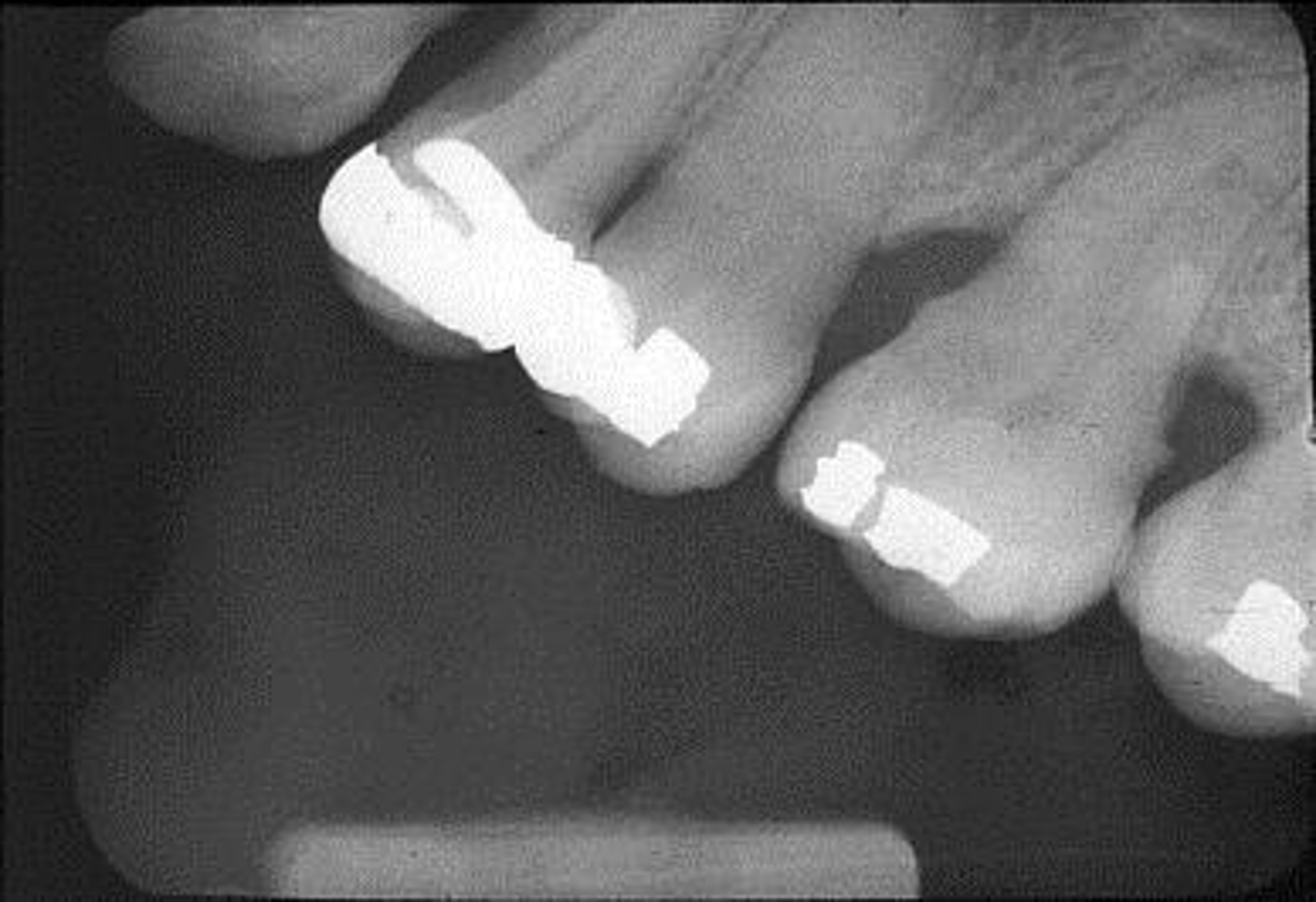 <p>Appearance-Occlusal plane appears tipped/tilted</p><p>Cause-Plate was not parallel to the incisal-occlusal surfaces of teeth</p><p>Correction-Make sure incisal-occlusal surfaces of teeth touch the bite-block (cotton roll under biteblock, not on the side of teeth to be radiographed)</p>