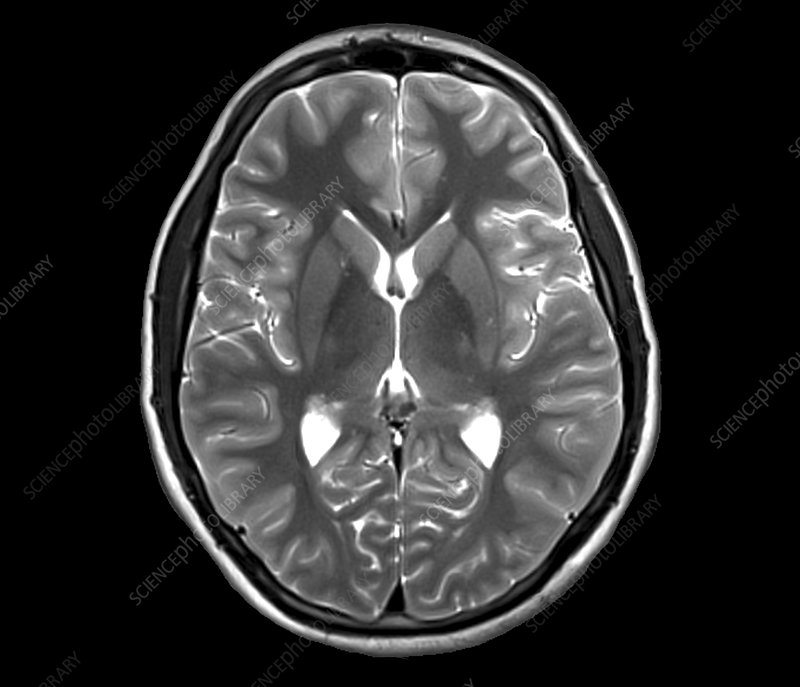 <p>Top of the brain slice (like a hamburger bun)</p>