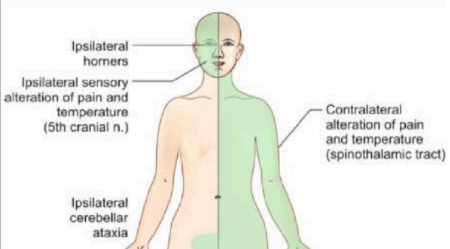 <p>A patient presents with numbness in this distribution, where is the lesion and cause</p>