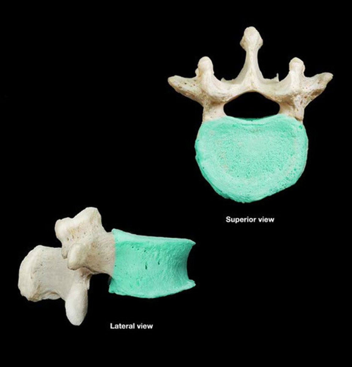 <p>thicker part of a vertebra that transfers weight along the axis of the vertebral column</p>