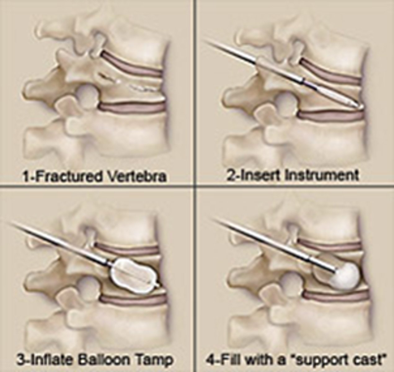 <p>Kyphoplasty</p>