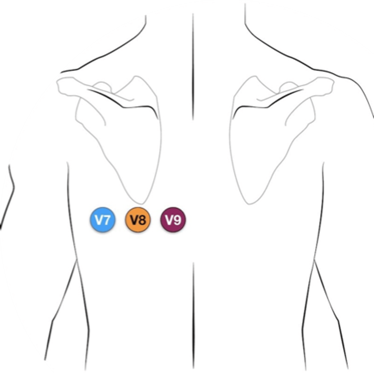 <p>- placed under left scapula</p><p>- V7, V8, V9</p><p>- most often, wires from V4-V6 are removed and placed on the back</p>