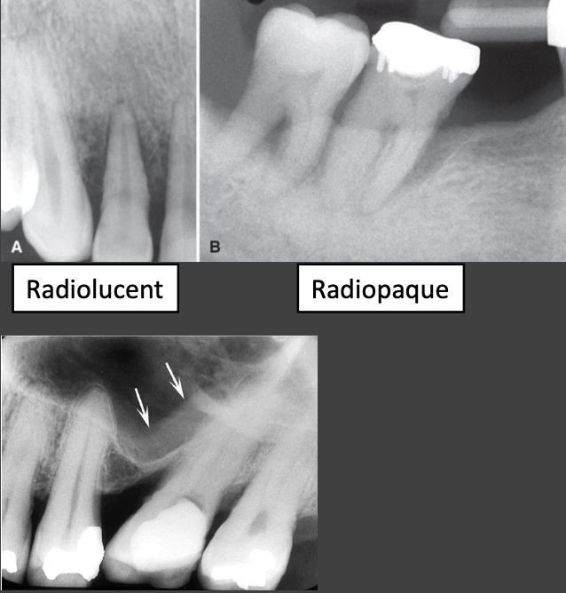 <ul><li><p>Periodontal diseases may stimulate adjacent</p><ul><li><p>Loss of bone density (rarefaction) - more common in early or acute lesions</p></li><li><p>Reactive bone formation (sclerosis) - may extend a distance from the periodontal lesion</p></li></ul></li><li><p>Usually see both</p></li><li><p>Rarely no apparent change in surrounding bone </p></li><li><p>Inflammatory products from lesion may diffuse through maxillary sinus floor to cause regional mucositis</p></li></ul><p></p>