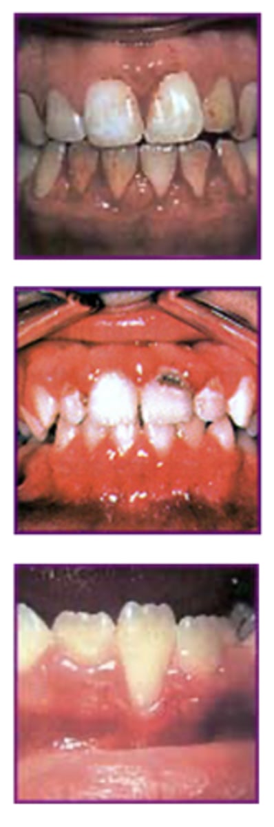 <p>Begins in “early adulthood”</p><p>•Now finding signs earlier in children</p><p></p><p><strong>Sign 1: Bleeding</strong></p><p>•Bleeding gums during tooth brushing, flossing</p><p></p><p><strong>Sign 2: Puffiness</strong></p><p>•Swollen and bright red gums</p><p></p><p><strong>Sign 3: Recession</strong></p><p>•Gums recede from teeth</p><p>•Sometimes roots exposed</p>