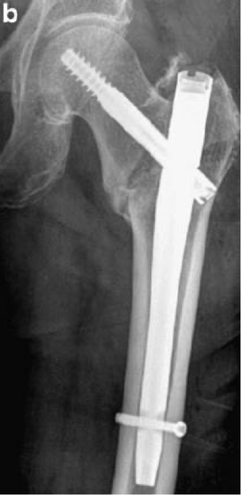 <p>-a longitudinal rod in the medullary canal of the femur </p><p>-aka IM nail</p>