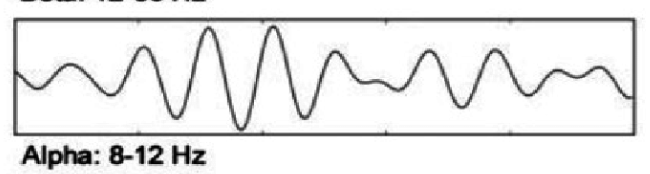 <p>What does this EEG show?</p>