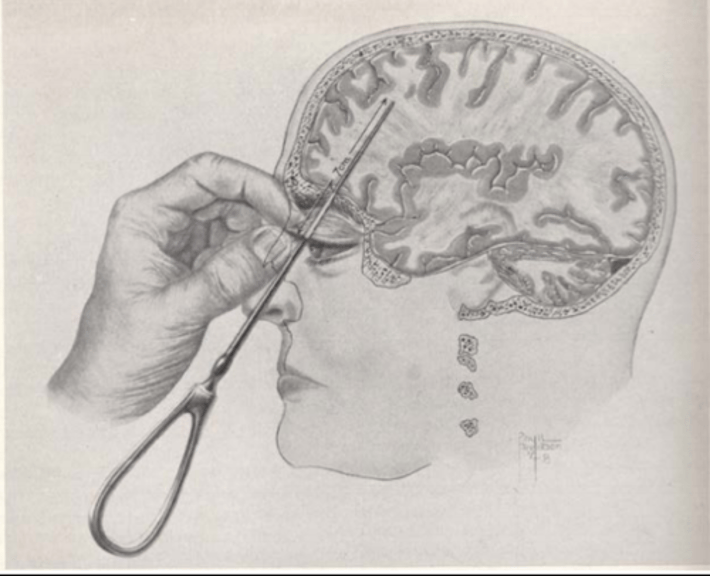 <p>a now-rare psychosurgical procedure used to calm uncontrollably emotional or violent patients by cutting the nerves that connect the frontal lobes to the emotion-controlling centers of the inner brain</p>
