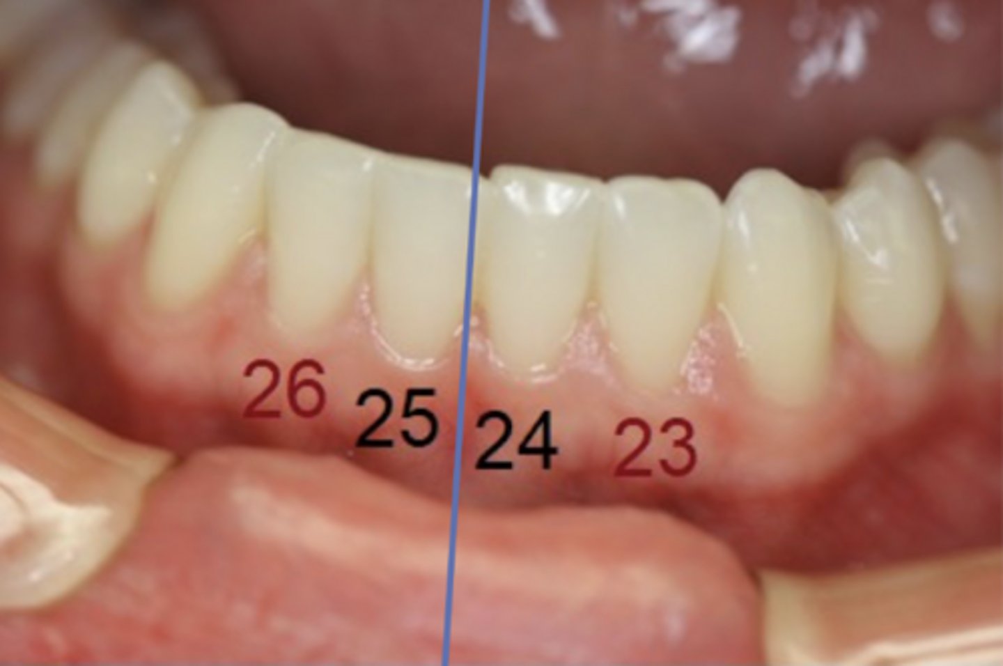 <p>Central and Lateral incisors</p>